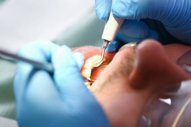 Best Knocked-Out Tooth (Avulsed Tooth) Treatment in Bemidji, MN